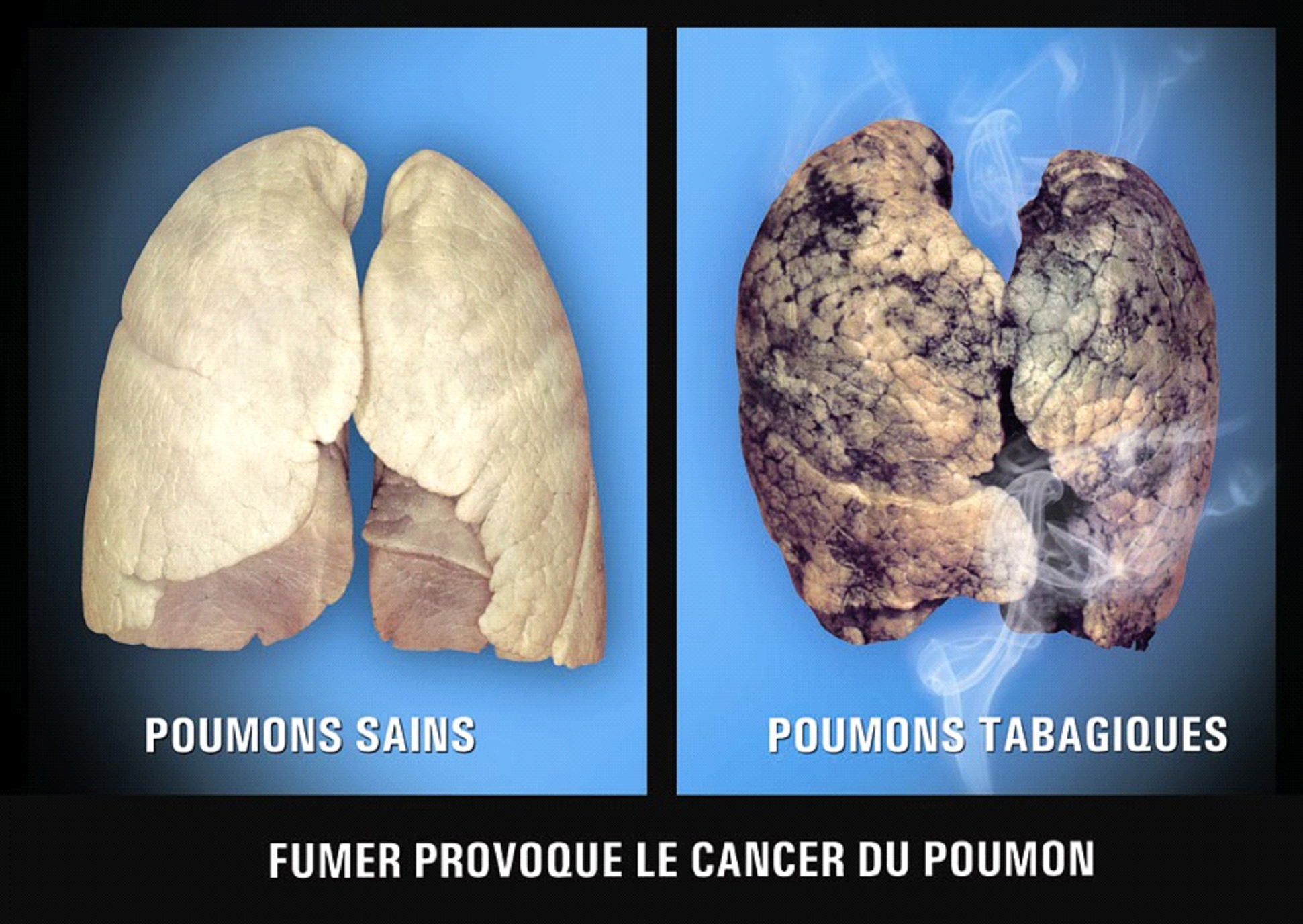 Mauritius 2009 Health Effects Lung - healthy vs unhealthy comparison, lung cancer